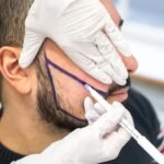 Beard Hair Transplant in Dubai