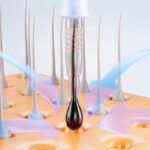 DHI Direct Hair Implant in Dubai